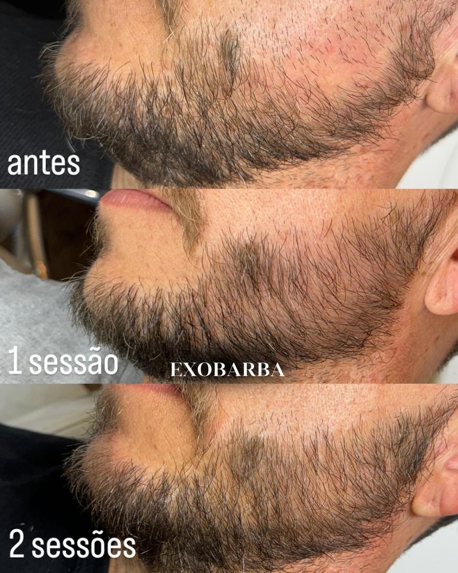 ExoBarba antes, depois de 1 sessão e depois de 2 sessões
