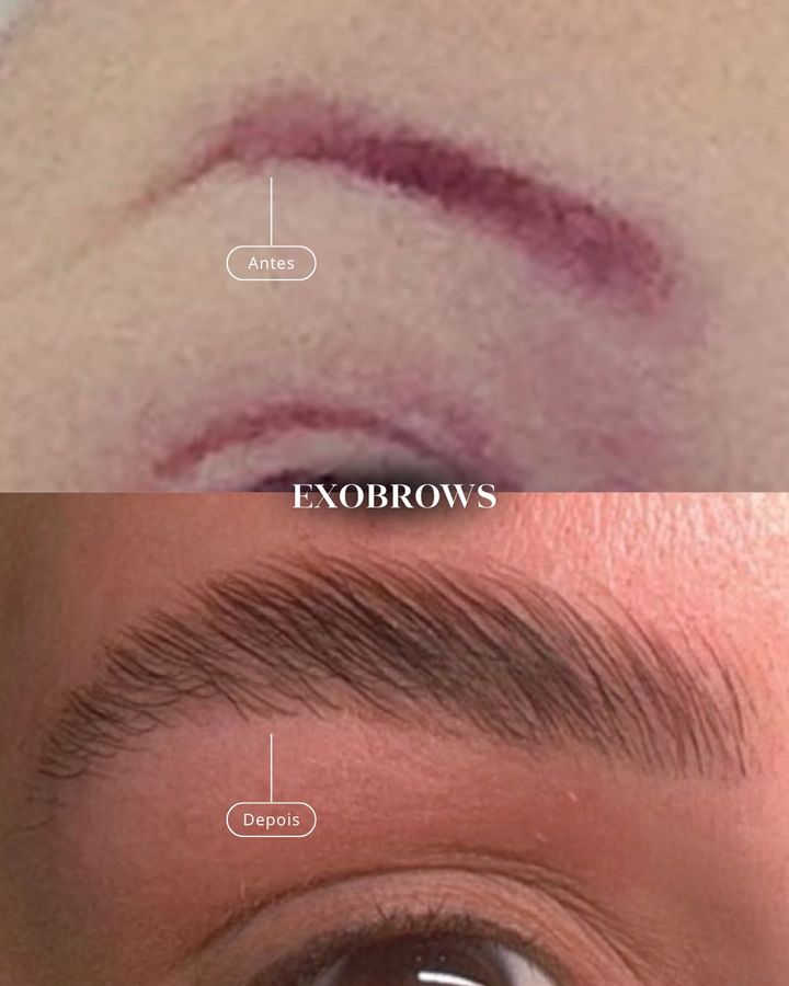 ExoBrows antes e depois em sobrancelha com micropigmentação antiga