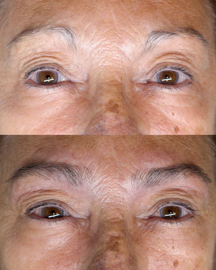 ExoBrows antes e depois