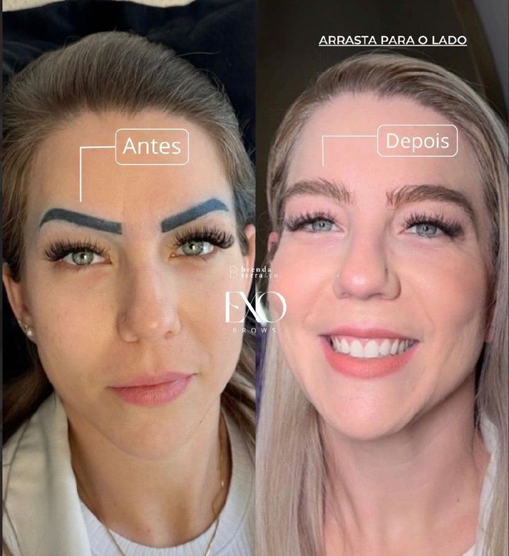 ExoBrows antes e depois em sobrancelha com micropigmentação antiga