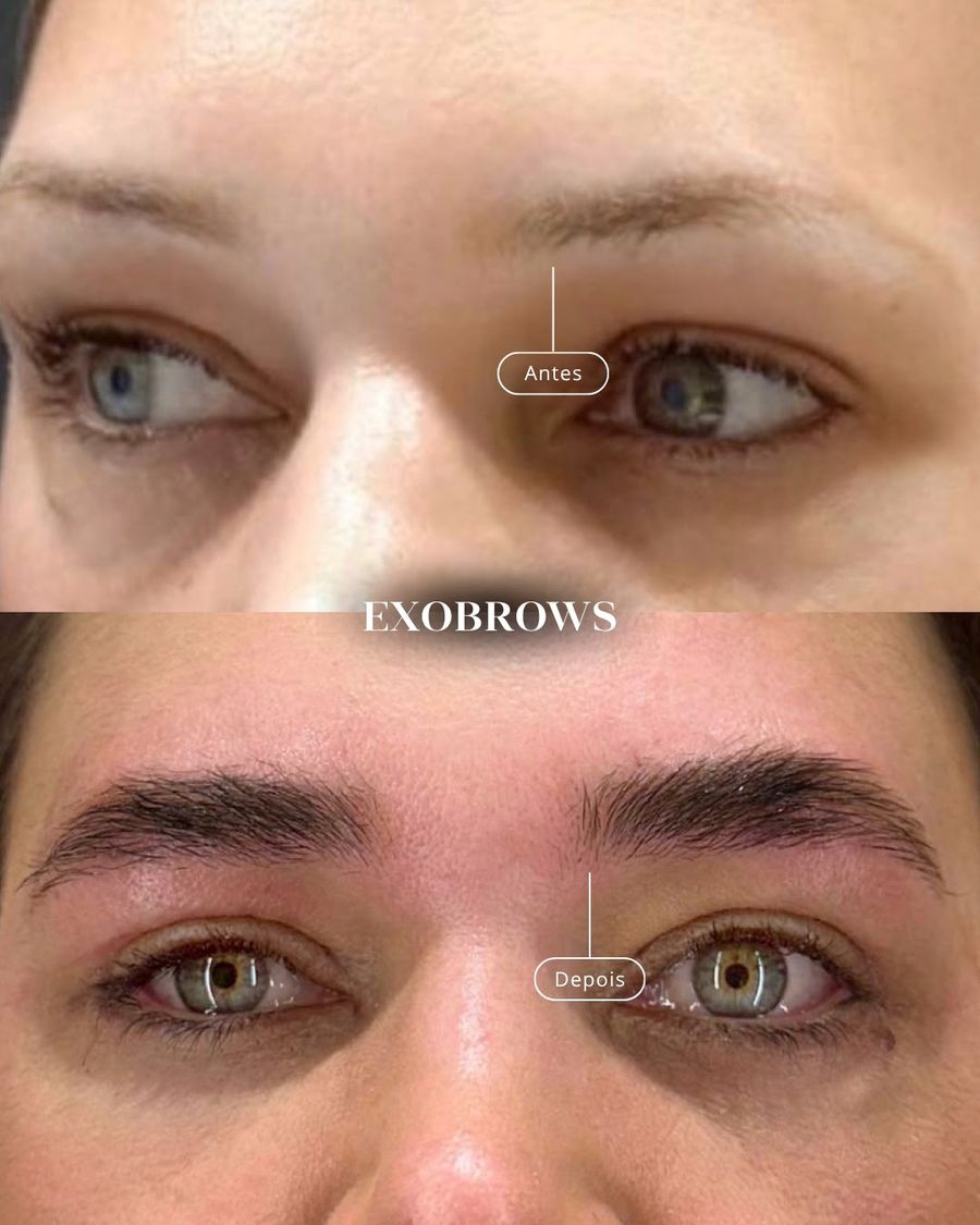 Antes e depois de sobrancelhas tratadas com ExoBrows