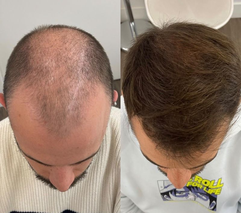 ExoHair antes e depois na coroa