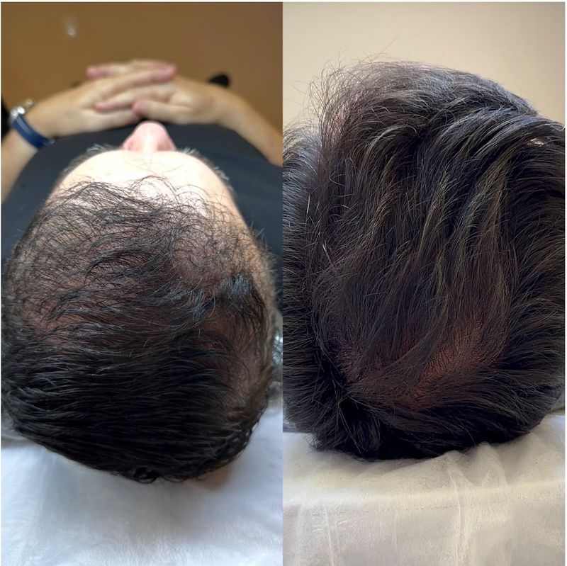 ExoHair antes e depois