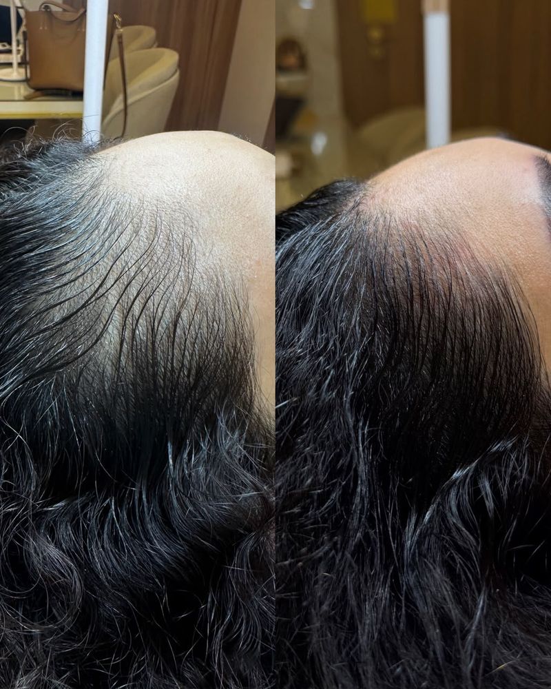 ExoHair antes e depois na linha frontal