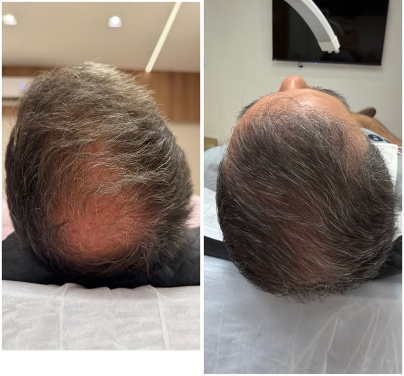 ExoHair antes e depois